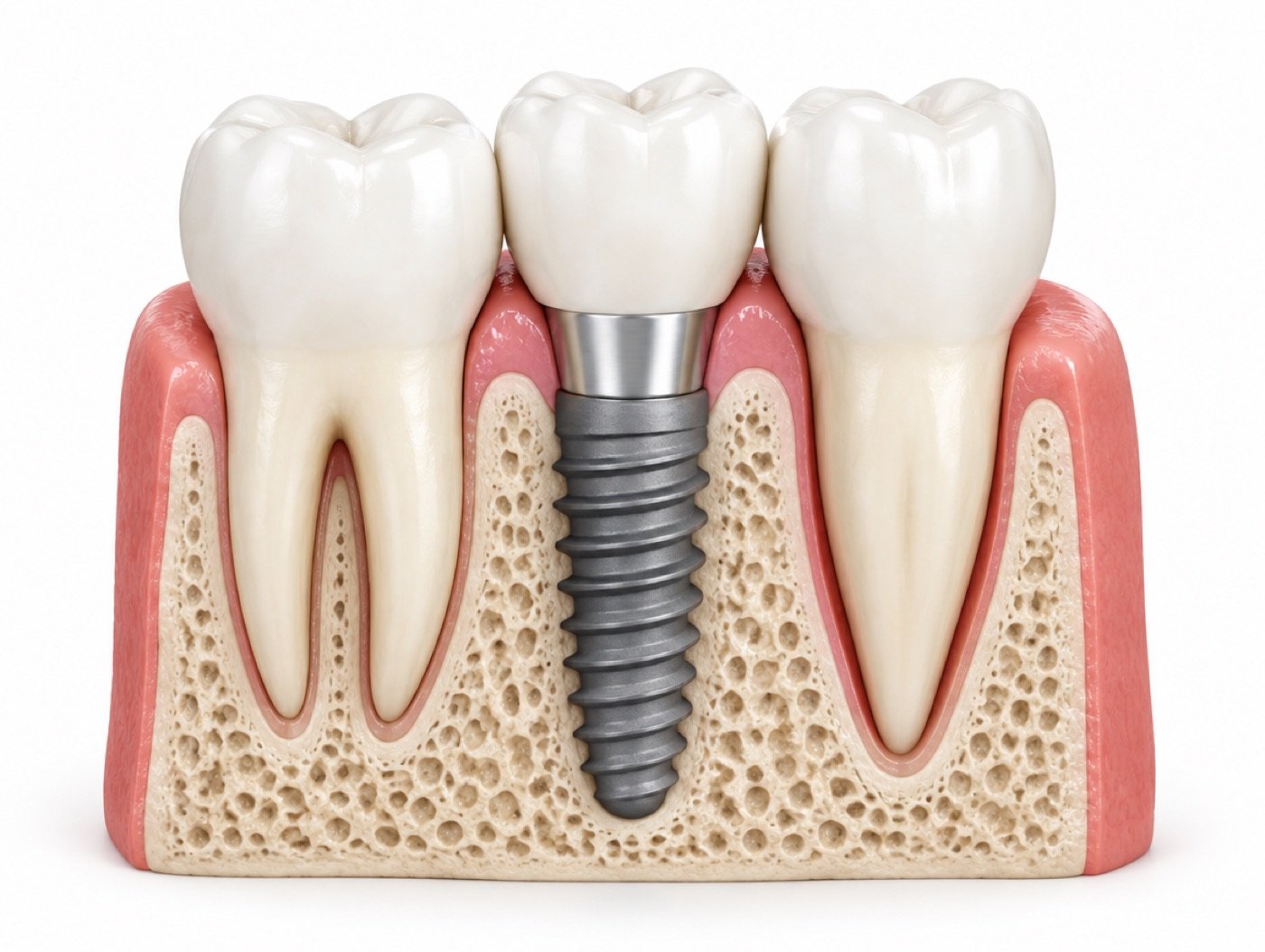 Implant, abutment and crown illustration