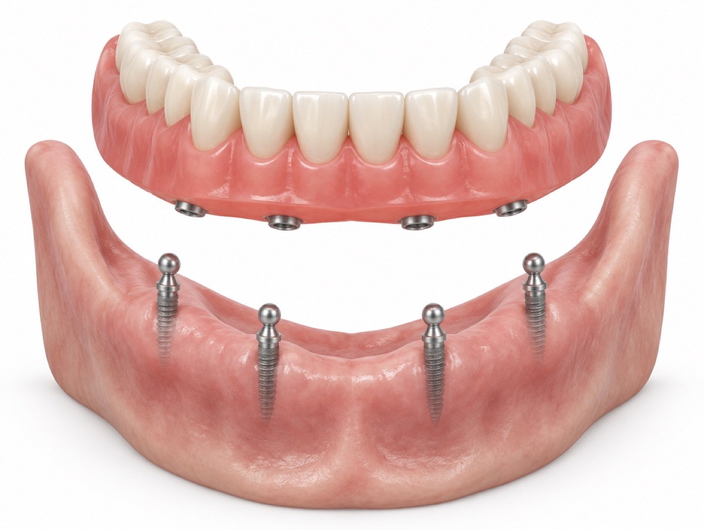 Mini implants with a removable denture