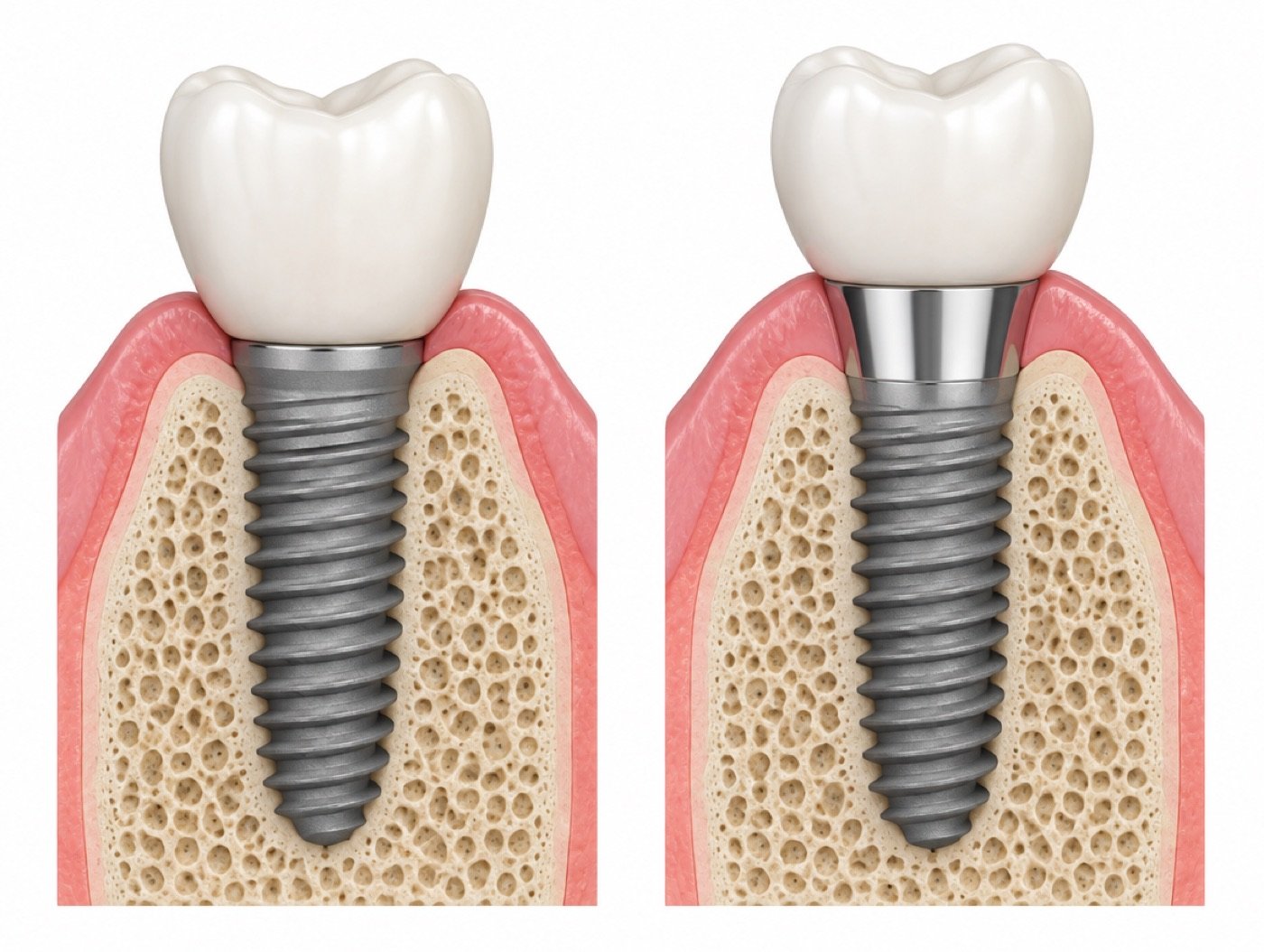 Tissue level vs bone level illustration