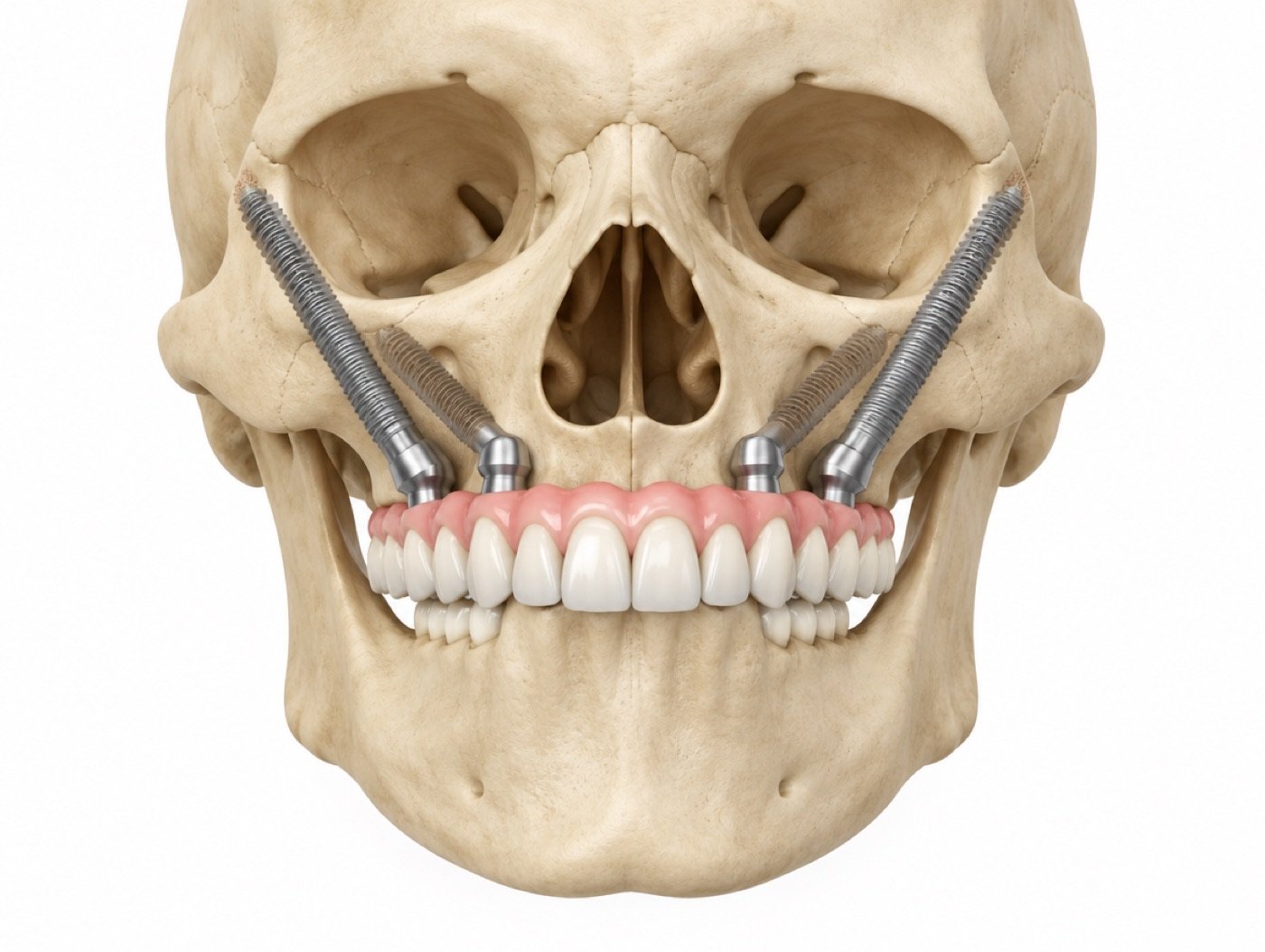 Illustration of zygomatic implants in a skull supporting an upper arch